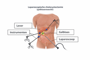 Laparoscopische cholecystectomie (galblaasresectie)